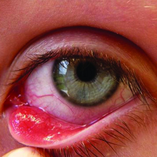 Фолликулярный конъюнктивит